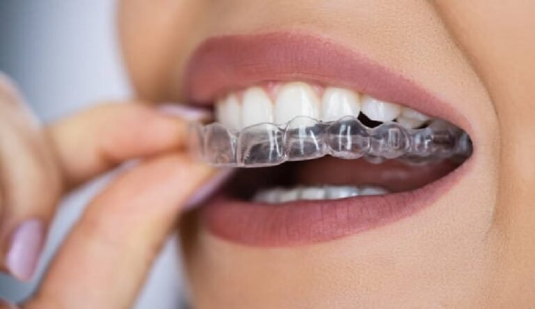 The Art of Smiling: Customising Invisalign for Unique Dental Needs